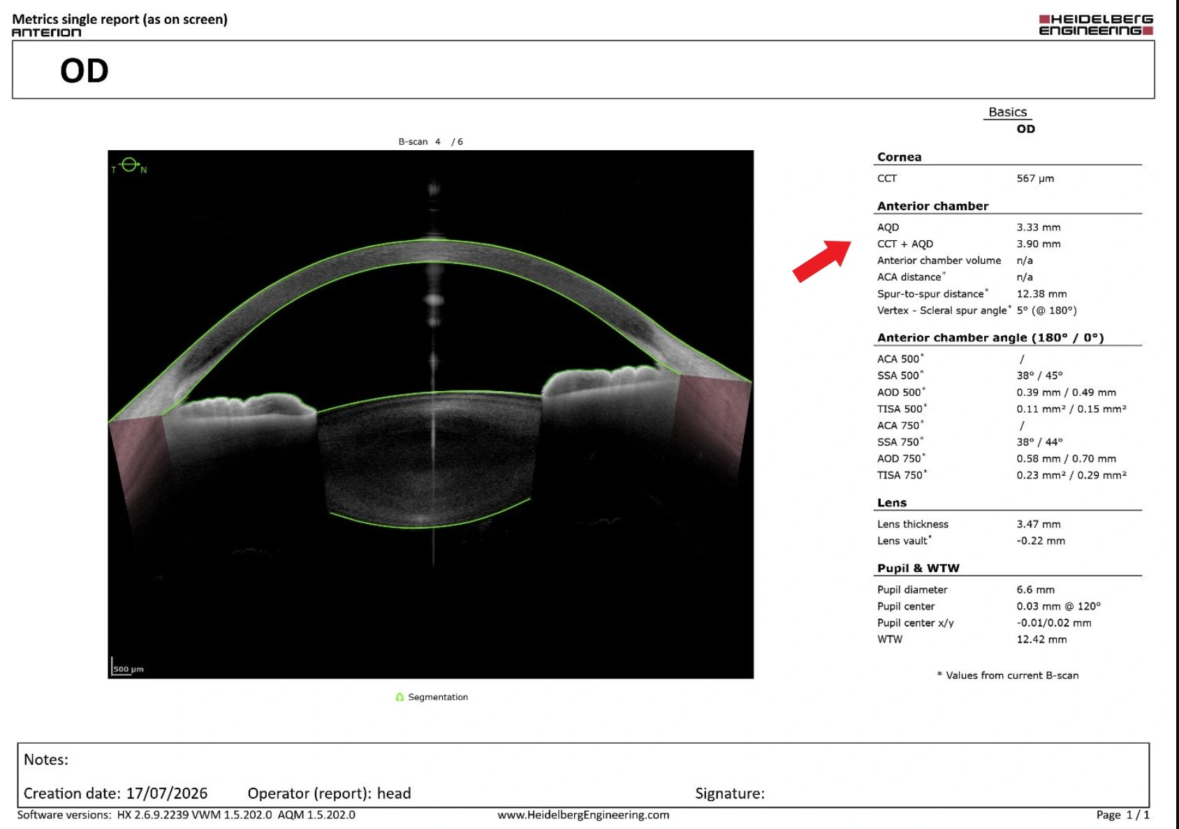 Anterion ACD measurement image