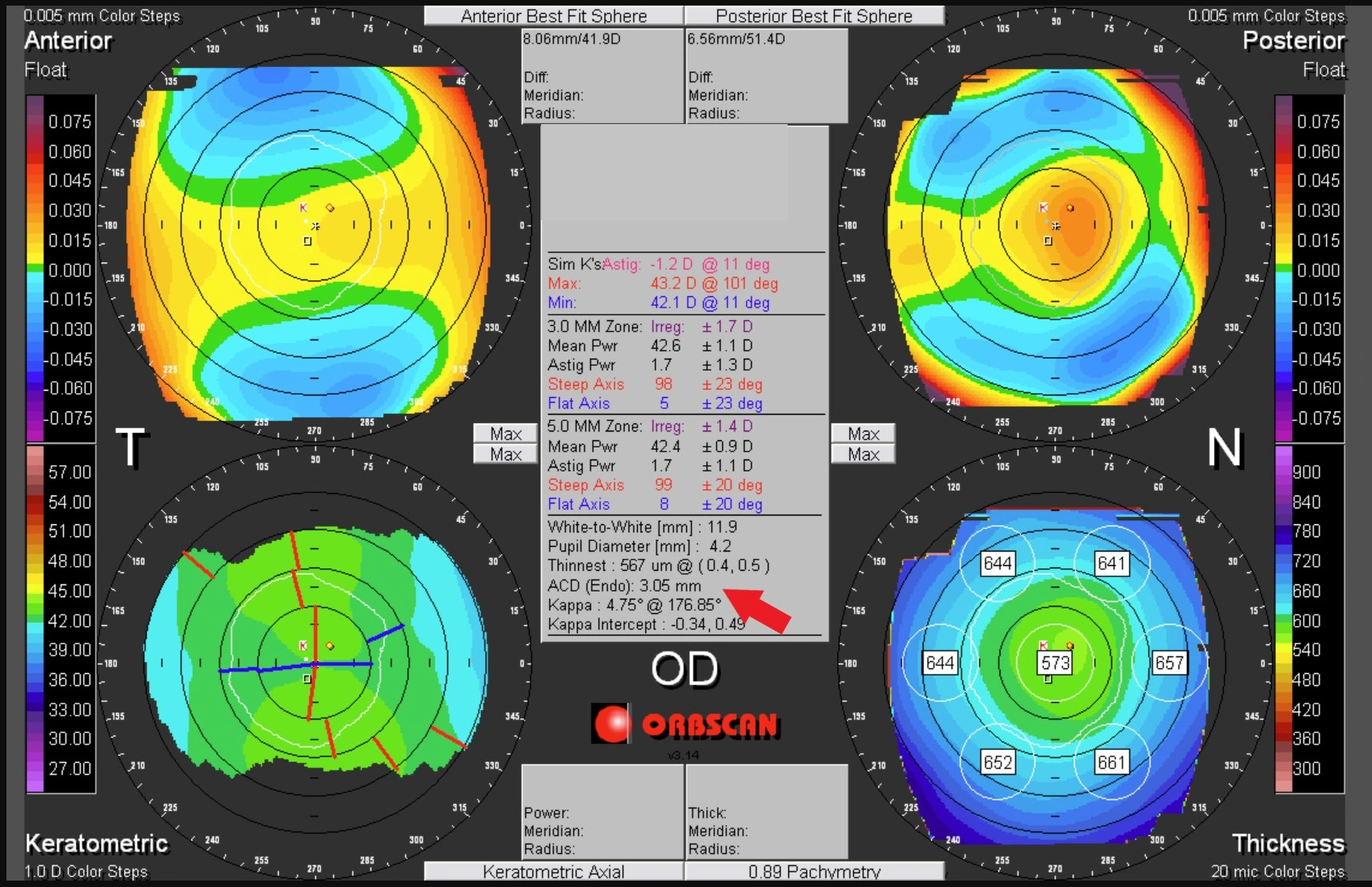 Orbscan ACD measurement image