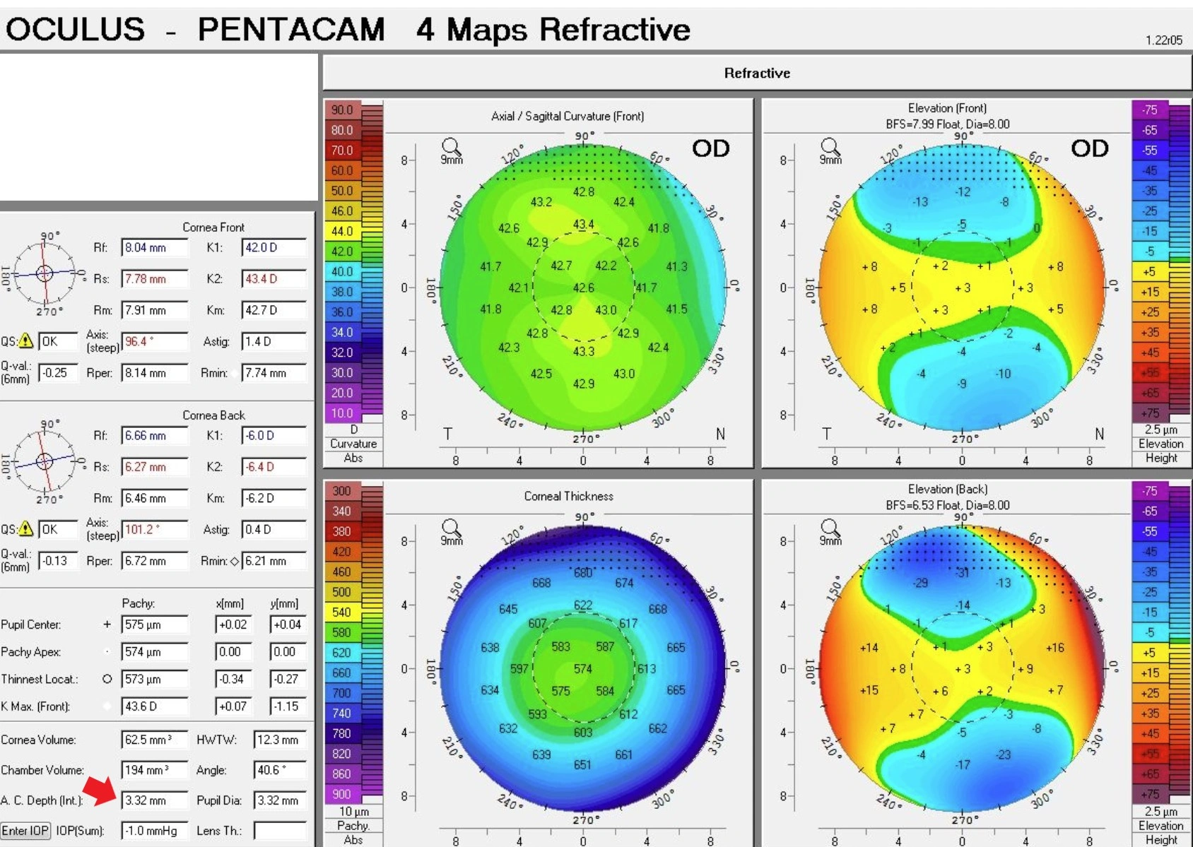 Pentacam ACD measurement image