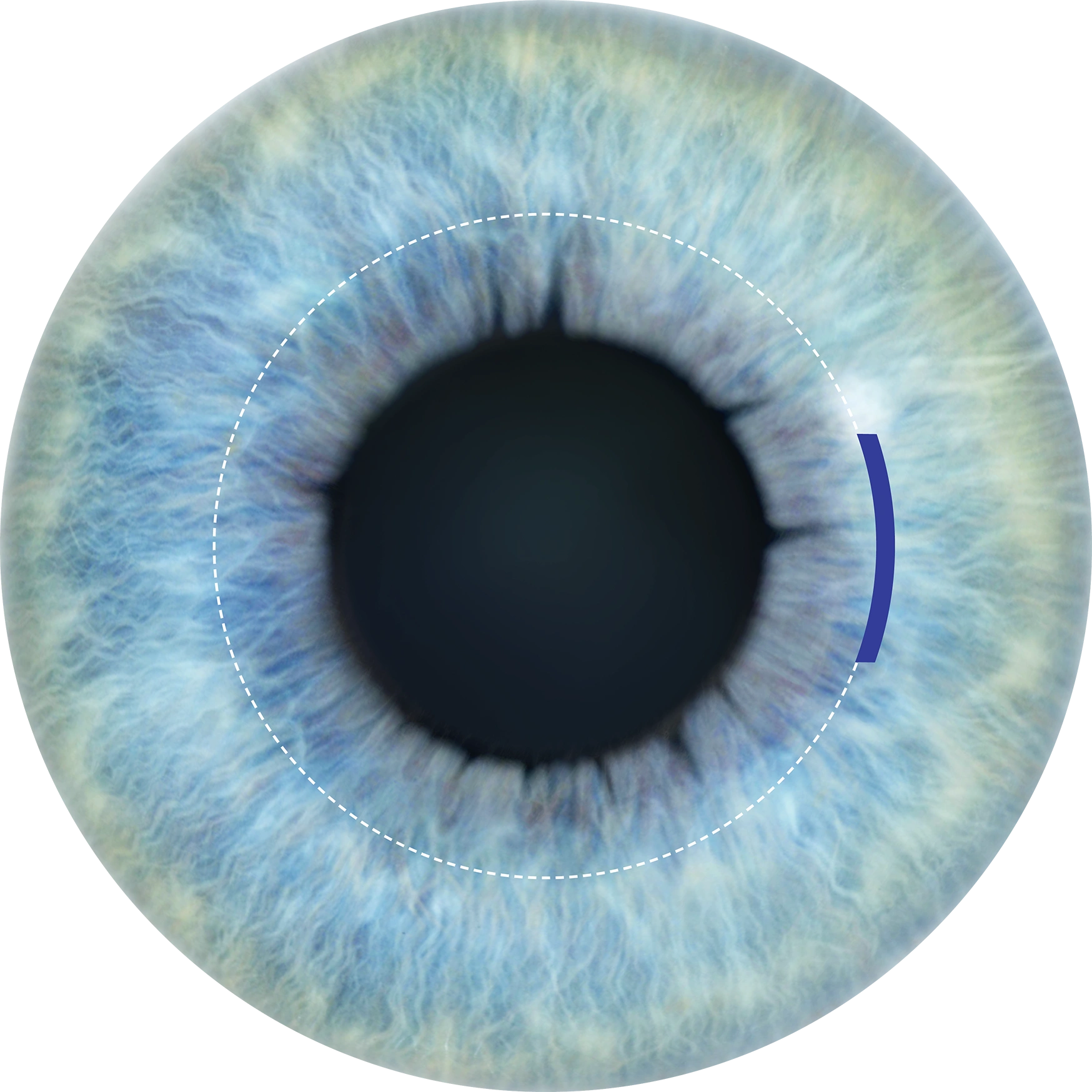Illustration of the ReLEx SMILE treatment zone and small corneal incision
