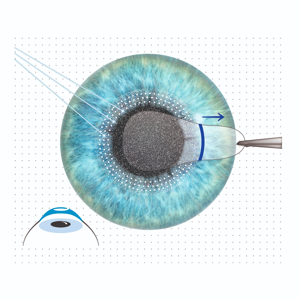 Patient undergoing SMILE laser vision correction treatment
