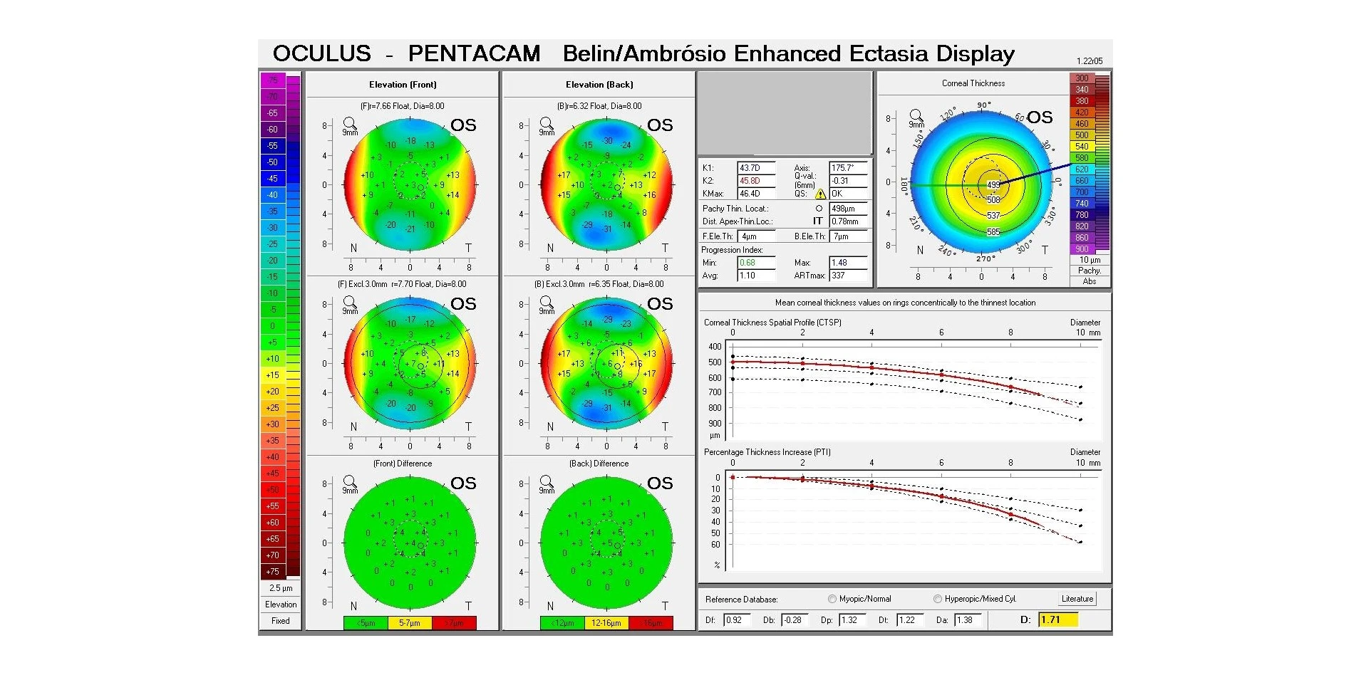 Corneal scan display of the type used when assessing the cornea for signs of ectasia
