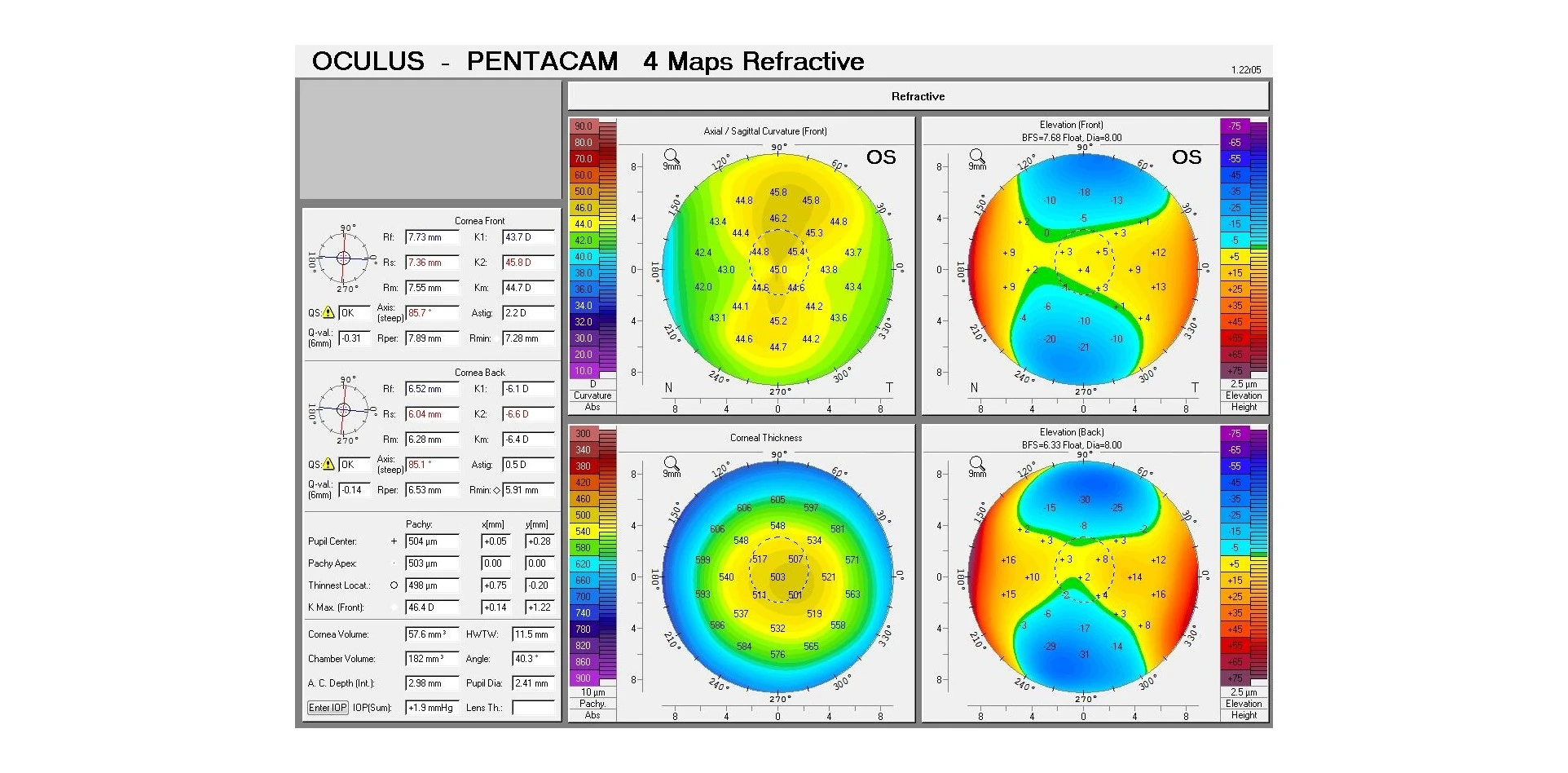 Corneal topography scan used to assess the cornea before LASIK Xtra at Advanced Eye Clinic & Surgery