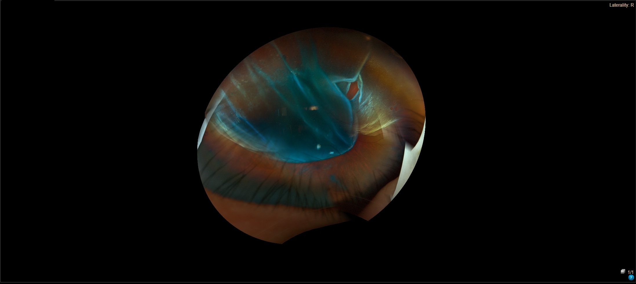 Pre-treatment retinal image