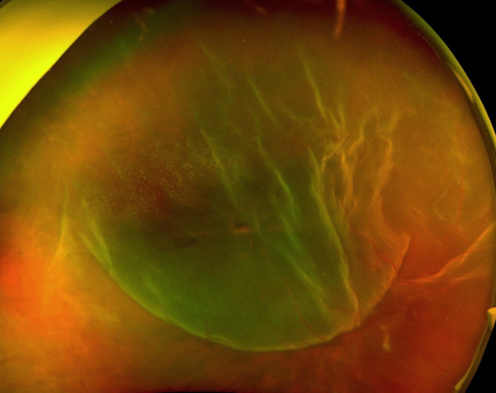 Retinal image showing an acute retinal detachment with small holes in the superotemporal periphery
