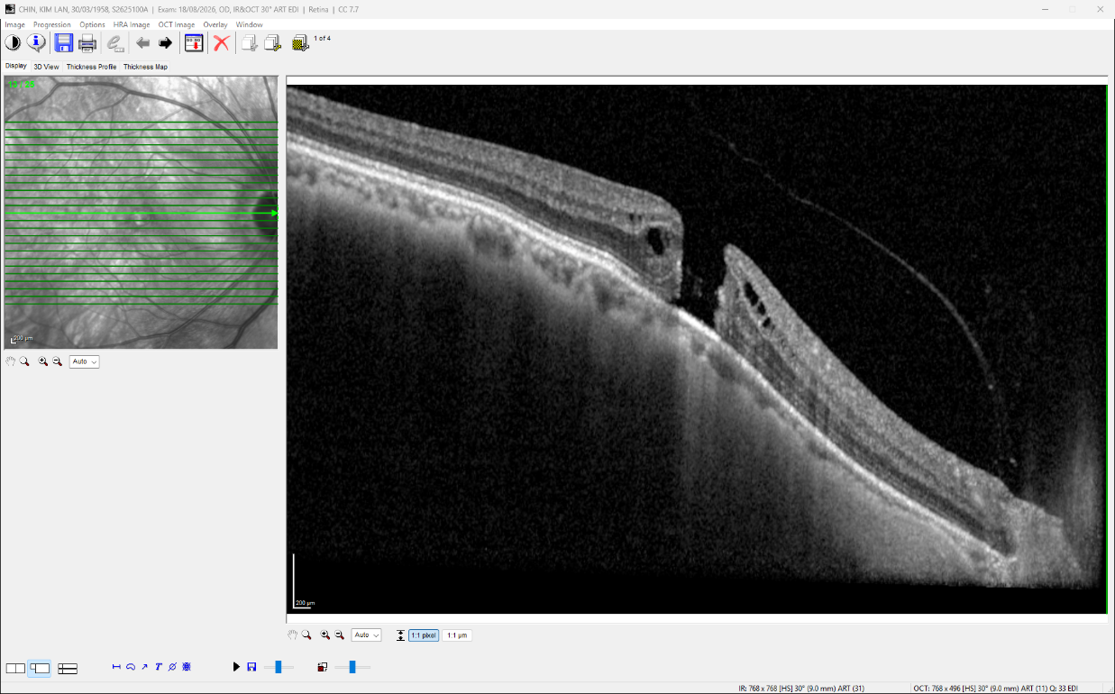 Preop OCT showing a Full thickness macula hole