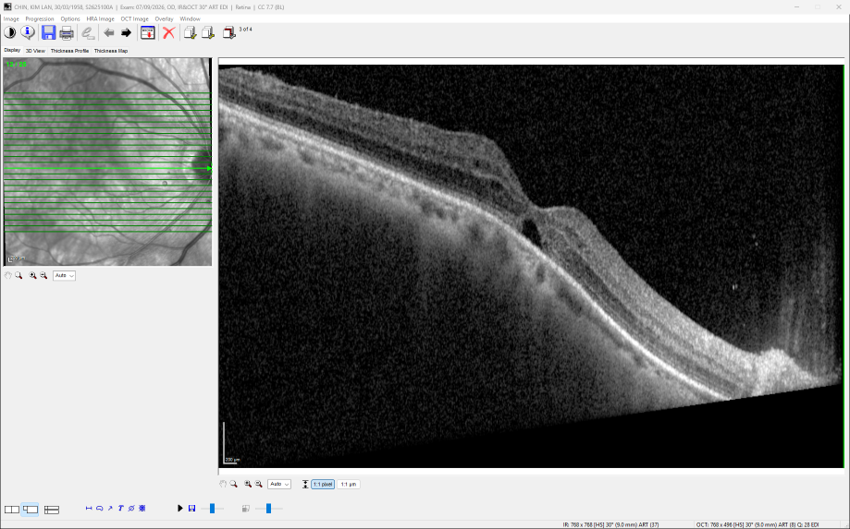 At 1 week postoperation, the macula hole is starting to close