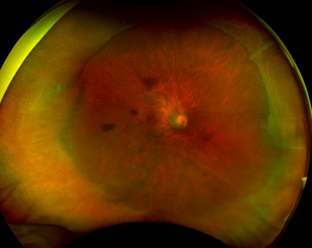 Retinal image showing the peripheral buckle indent, with retinal thinning and small holes at the 9 to 10 o'clock area